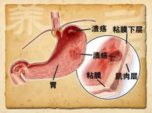 胃溃疡症状表现有哪些