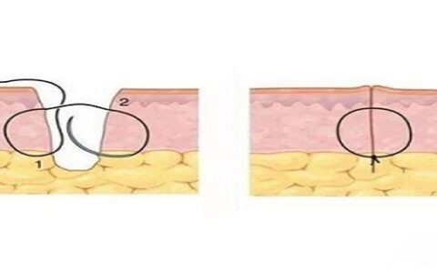 伤口久不愈合的一招灵
